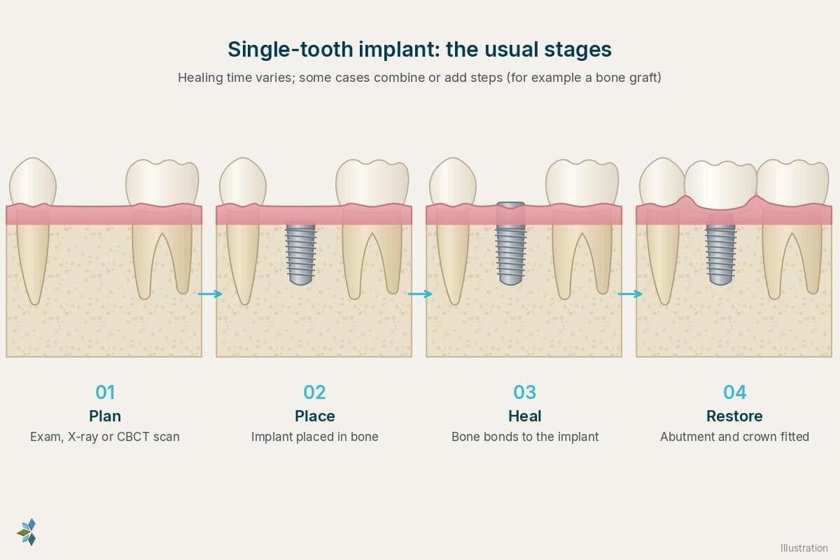 Four-panel illustration of single-tooth dental implant stages: planning, implant placement, healing and crown fitting