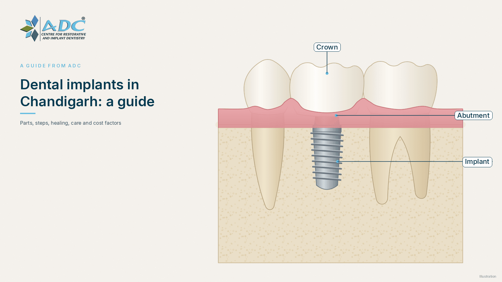 Dental implants in Chandigarh: a complete guide