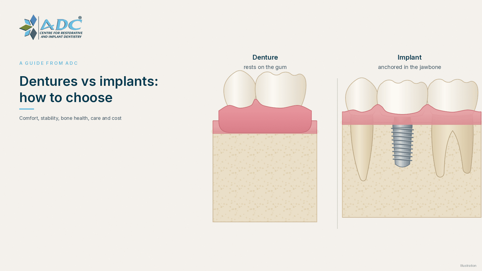 Diagram comparing a denture resting on the gum with a dental implant crown anchored in the jawbone