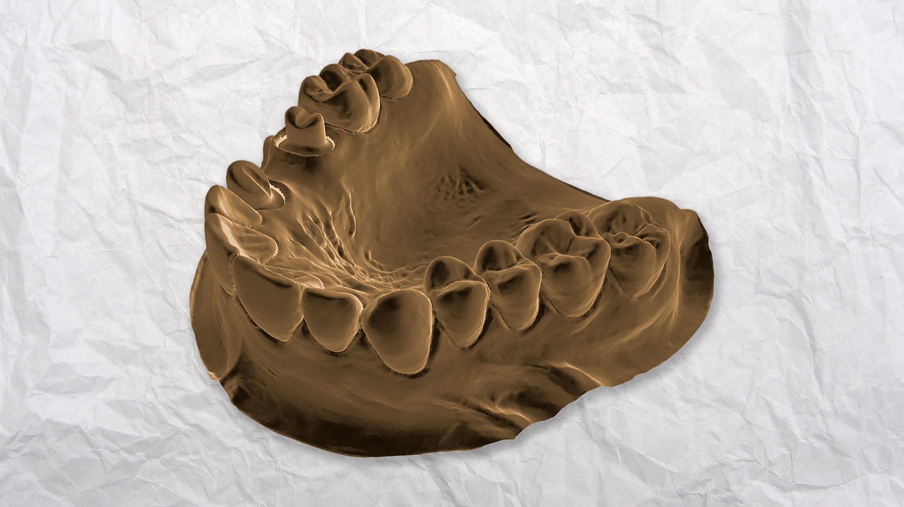 What are Dental Bridges and Crowns