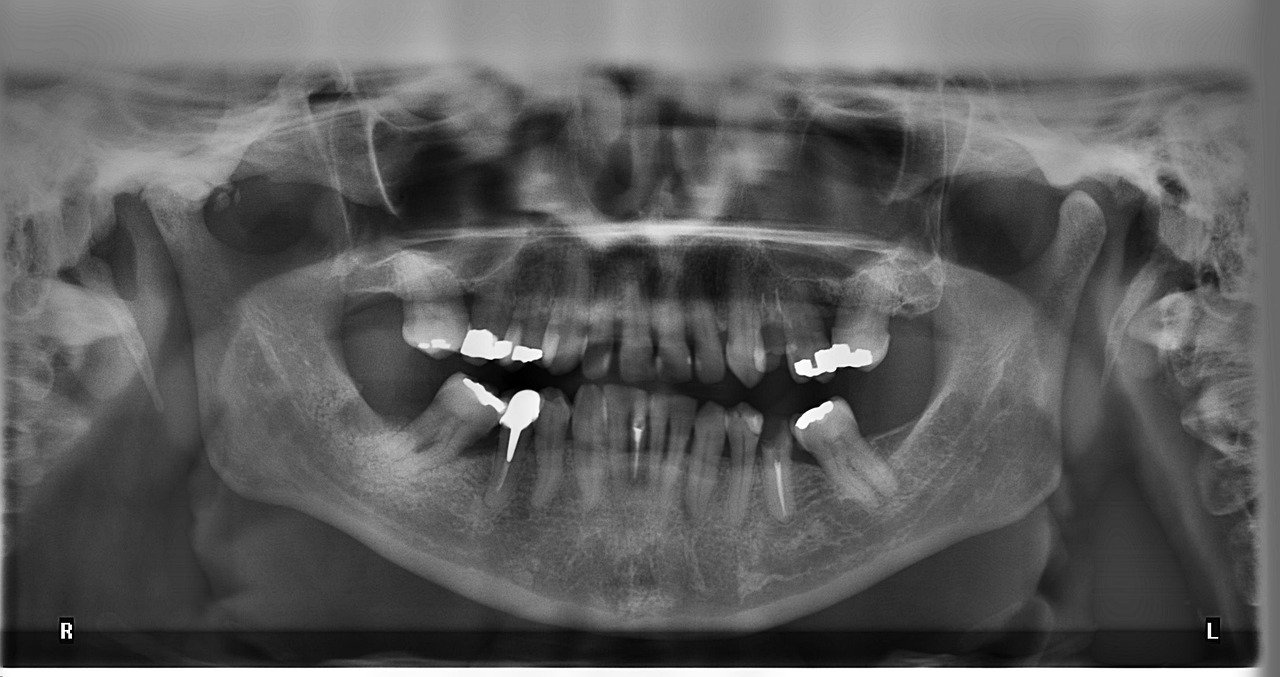 Seamless Dental Restoration