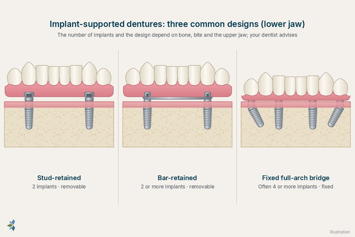 Three lower implant-supported denture designs: stud-retained on two implants, bar-retained, and a fixed full-arch bridge on four implants