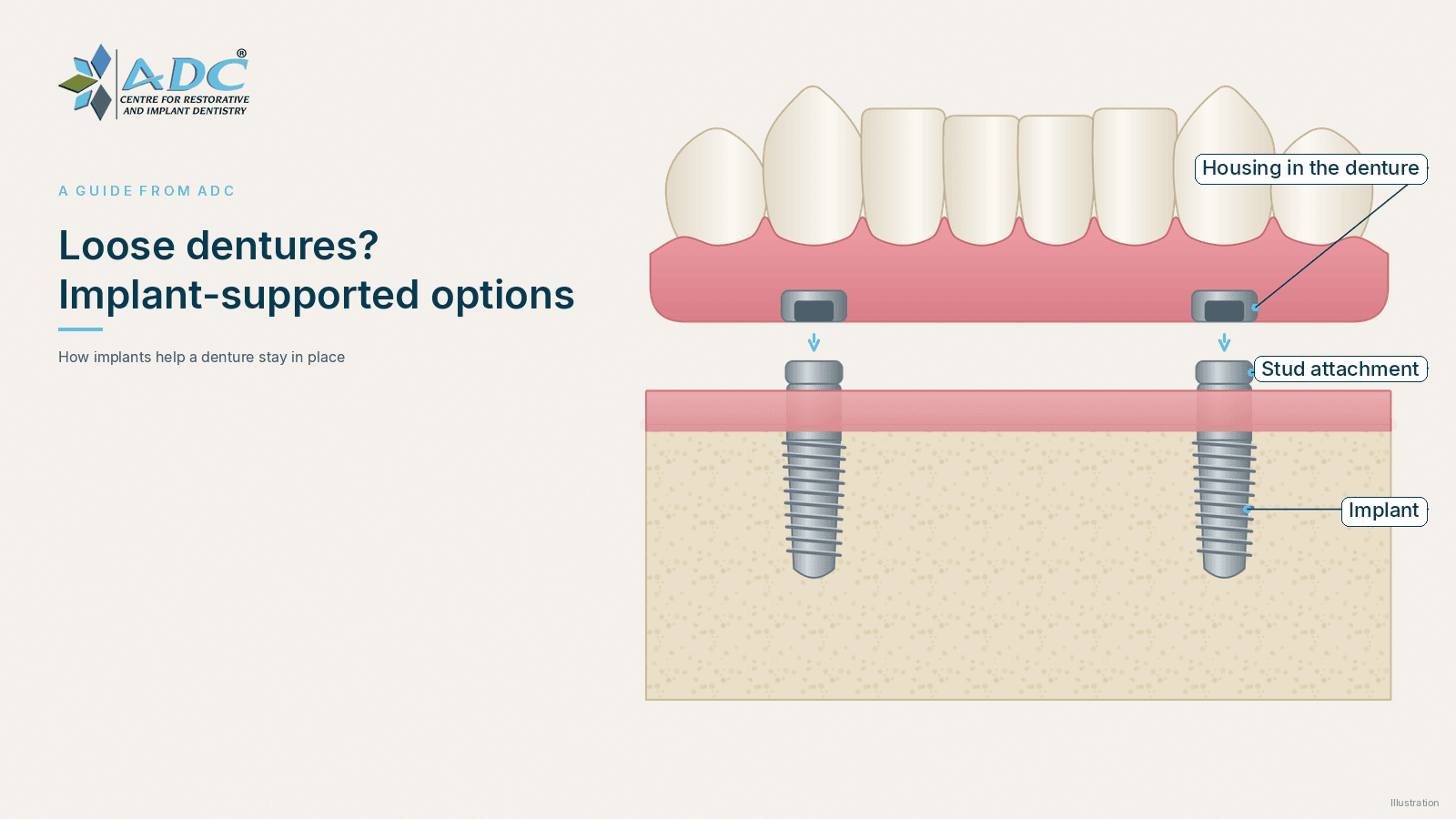 Loose dentures? Implant-supported dentures in Chandigarh
