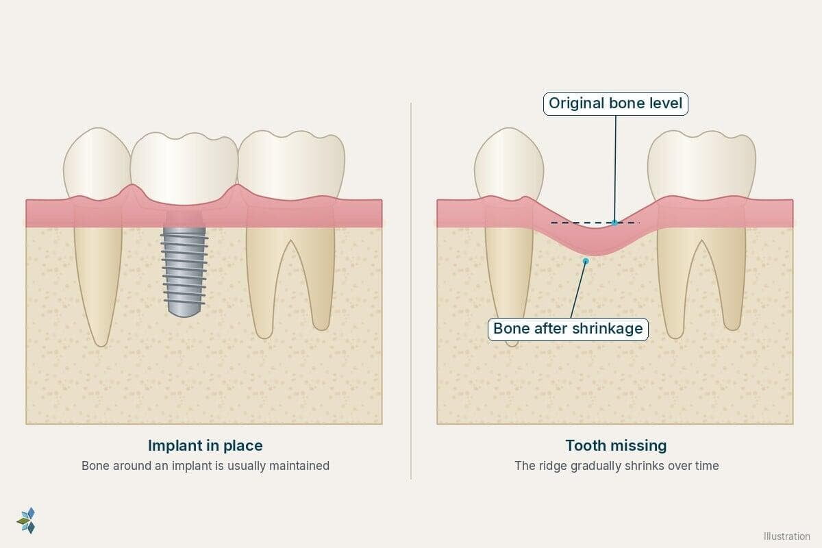 Two panels comparing bone around a dental implant with a shrunken ridge where a tooth is missing