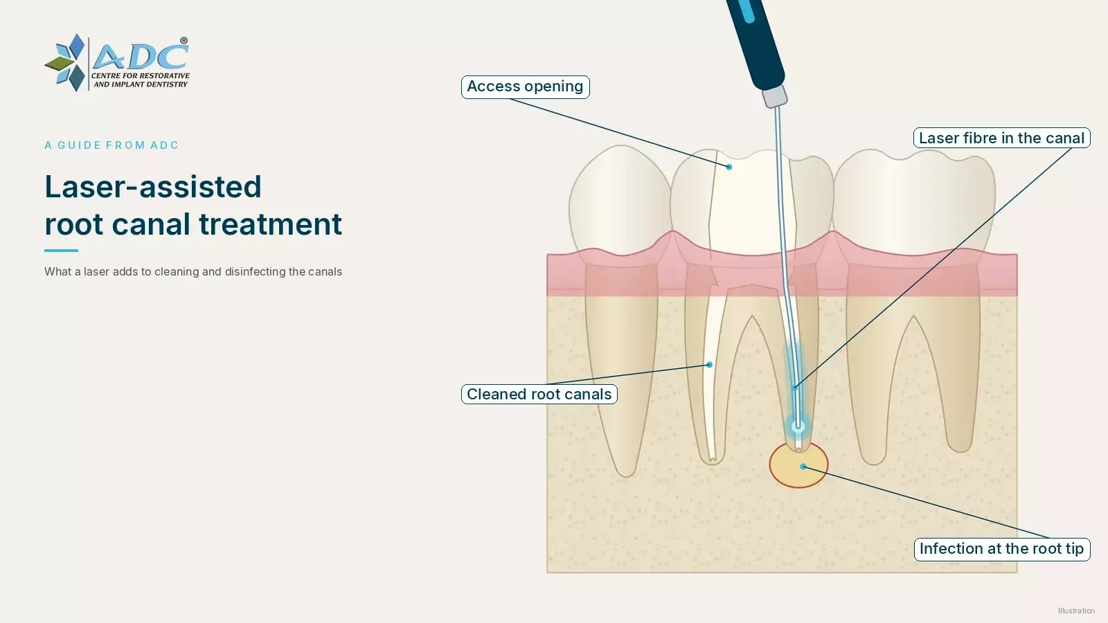 Laser root canal treatment in Chandigarh: what it adds