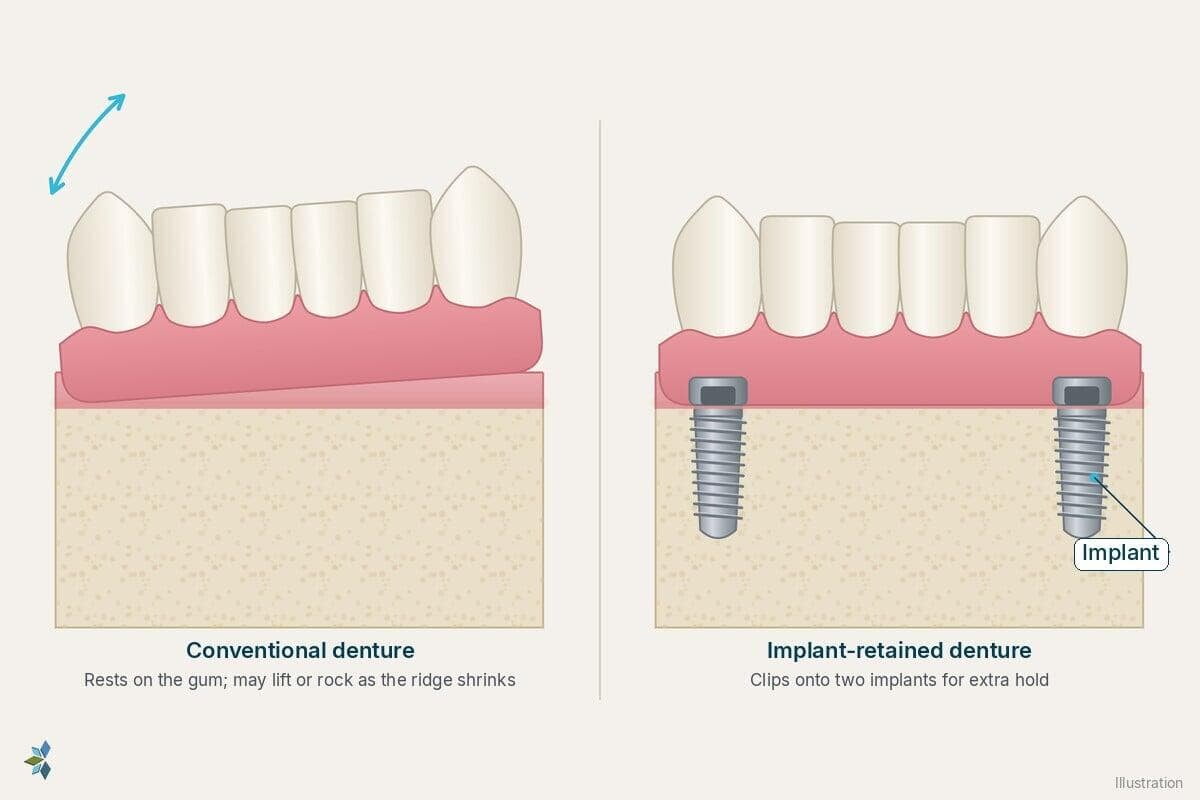 Conventional lower denture rocking on a shrunken ridge beside an implant-retained denture clipped onto two implants