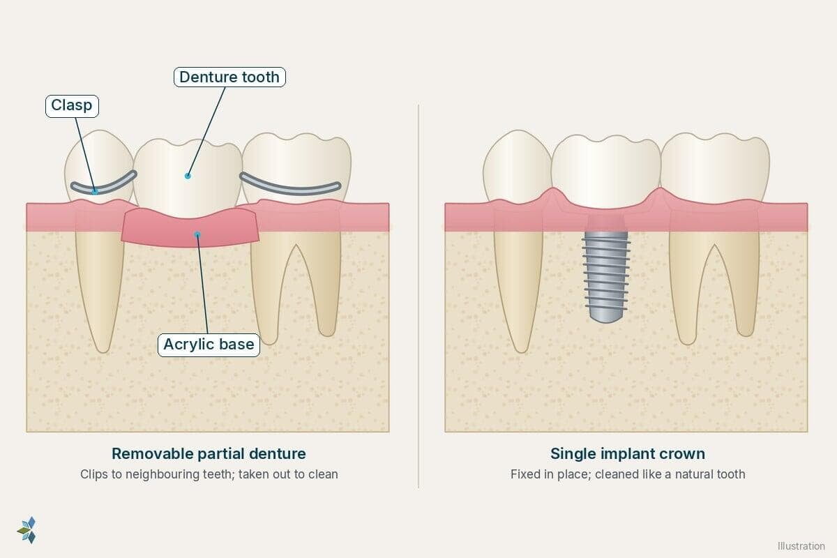 Removable partial denture with a clasp beside a single implant crown, illustrating dentures vs implants for one missing back tooth