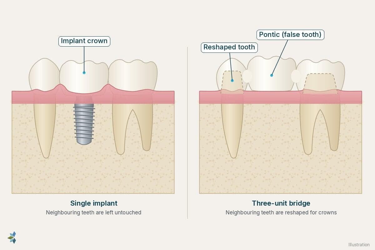 Single dental implant crown compared with a three-unit bridge that needs the neighbouring teeth reshaped