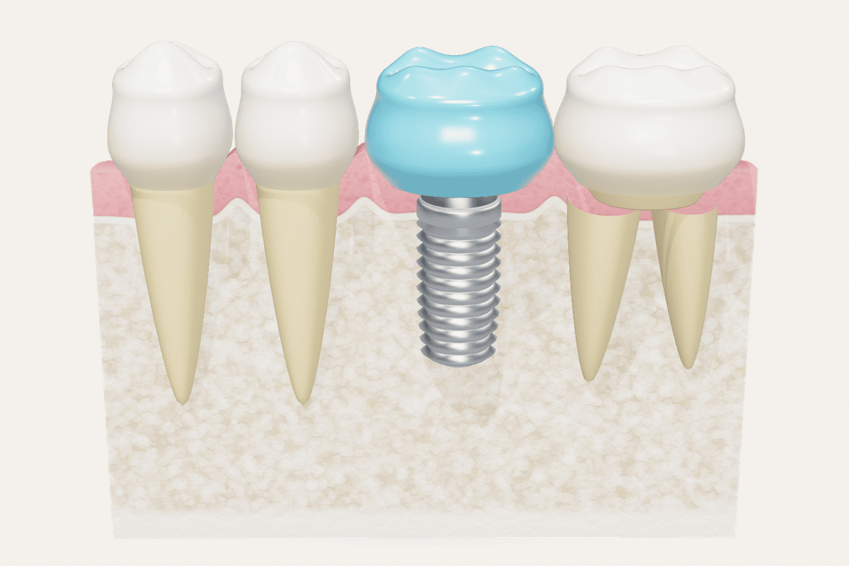 Cross-section illustration of an implant fixture, abutment zone and crown in the jaw