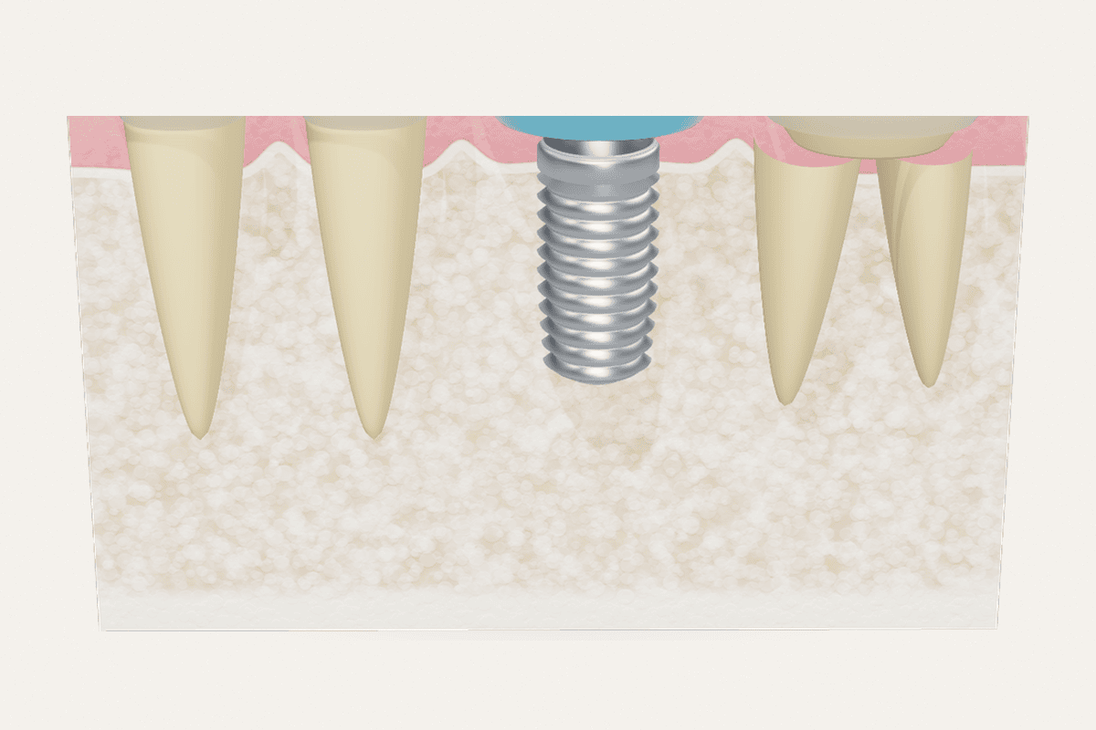 Close illustration of an implant fixture within jawbone