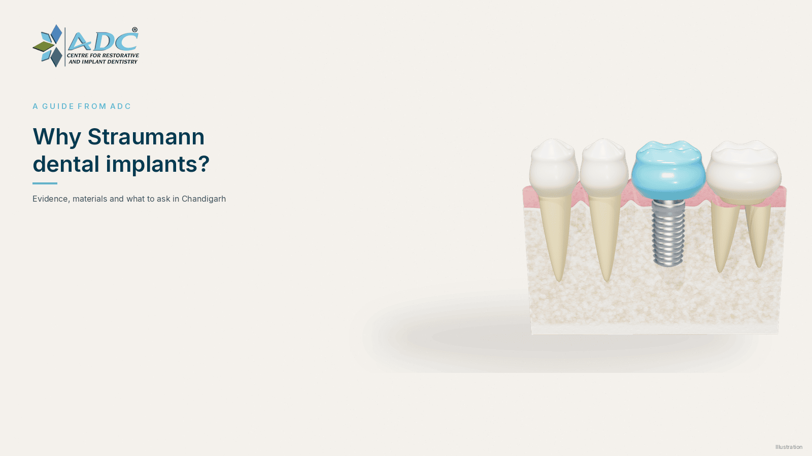 Illustrative cross-section of a dental implant in bone with neighbouring teeth