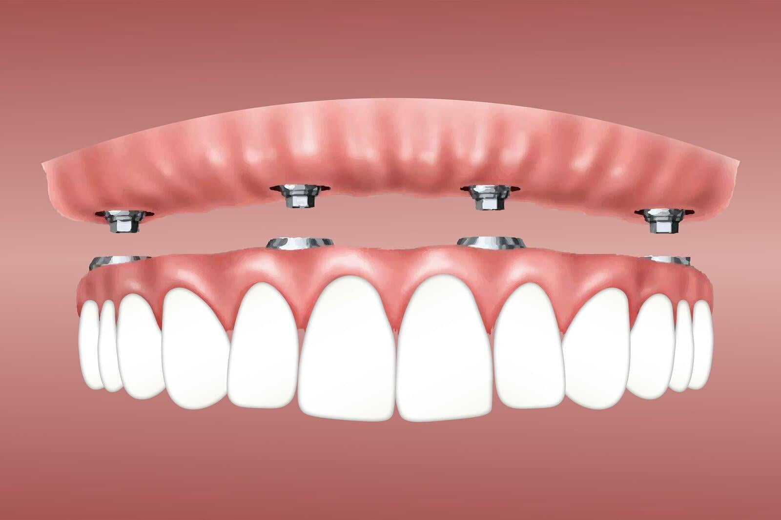 Understanding Dental Implant Overdentures? 