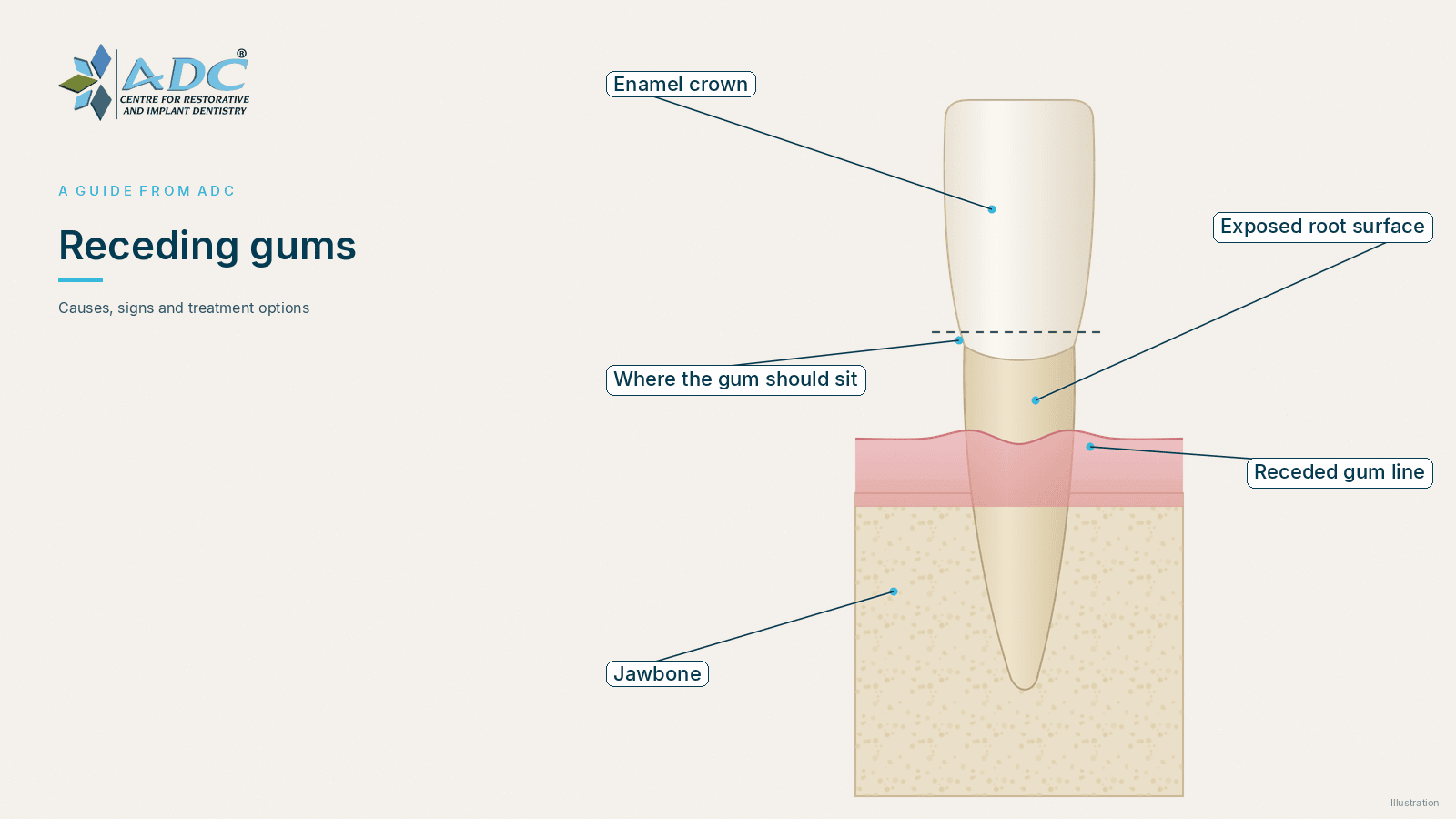 Receding gums: causes, signs and treatment