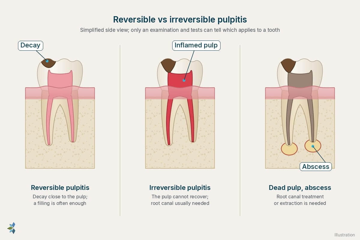 Three lower molars side by side: reversible pulpitis with decay close to a healthy-looking pulp, irreversible pulpitis with deep decay reaching an inflamed pulp, and a dead pulp with an abscess at the root tips