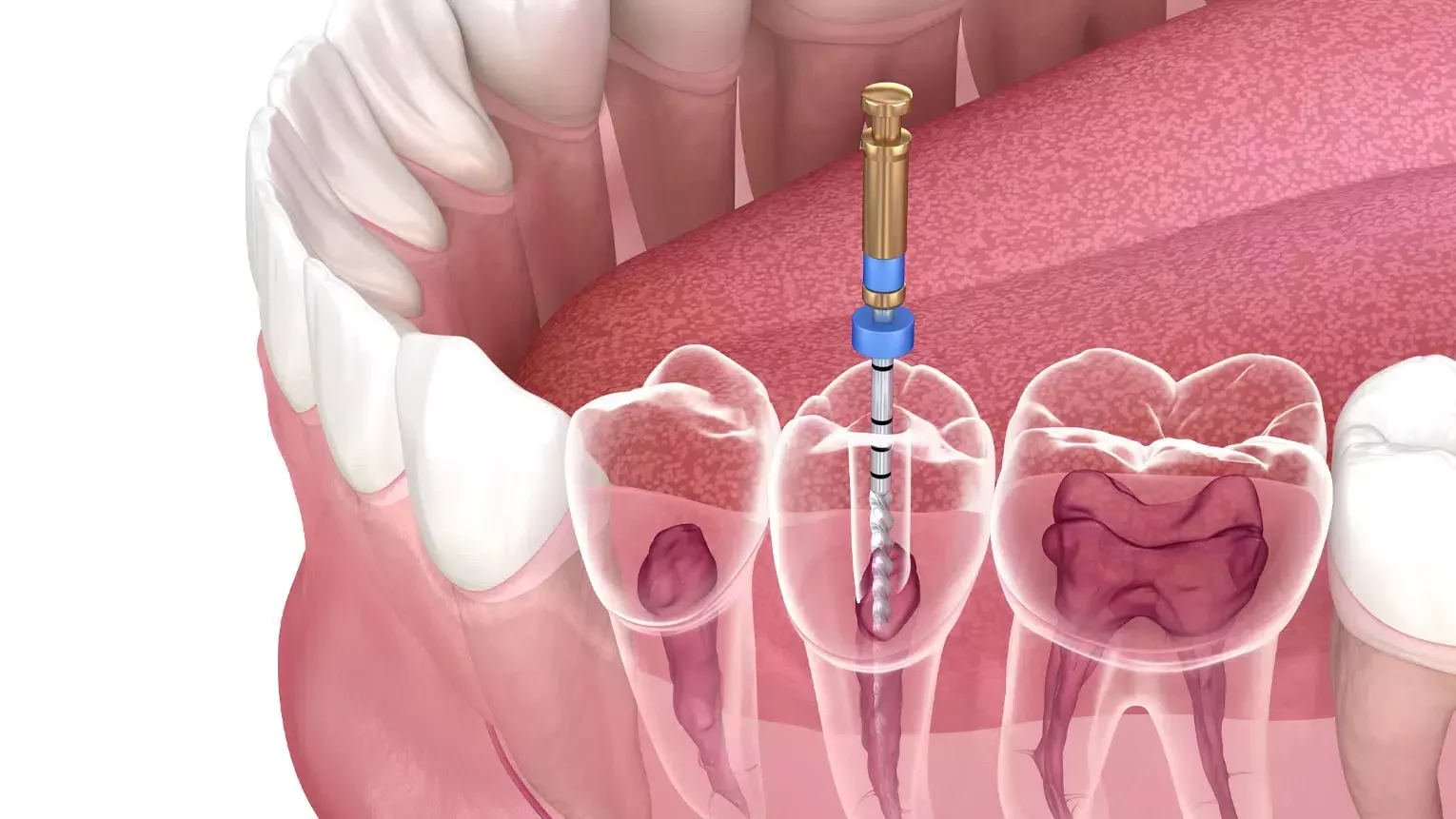 What Happens During a Root Canal? Step-by-Step