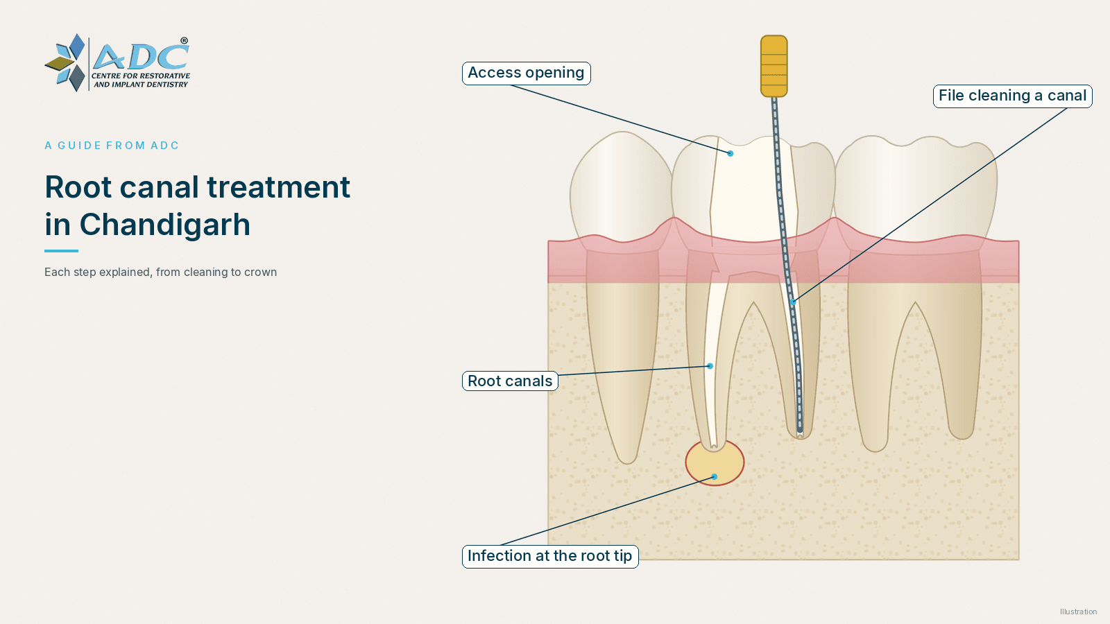 Root canal treatment in Chandigarh: a patient's guide