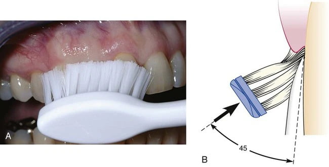 brushing teeth at 45 degrees