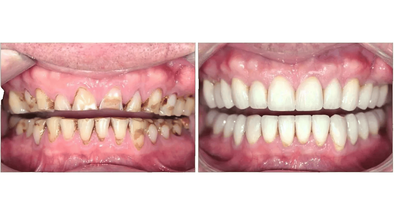 Severely Worn Teeth: When You May Need Full Mouth Rehabilitation